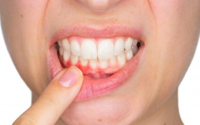  5 Common Causes of Bleeding Gums – 2022